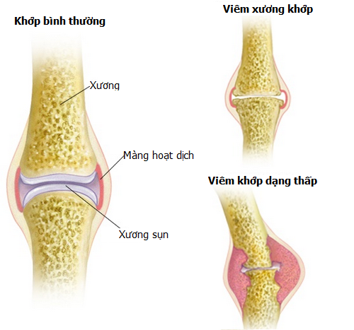 Bệnh thoái hóa khớp là gì