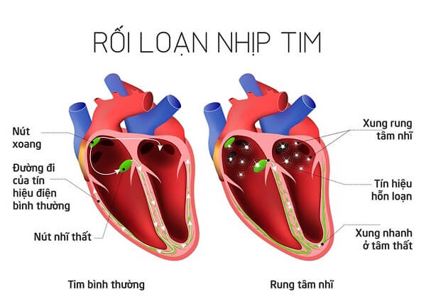 benh-ly-tim-mach-roi-loan-nhip-tim