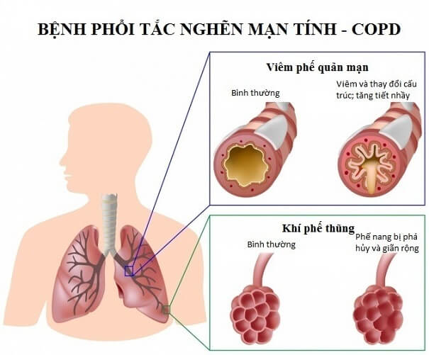 benh-phoi-tap-nghen-copd-2