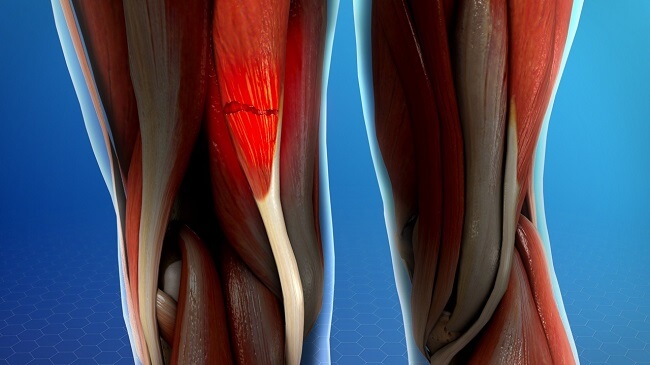 chan-thuong-co-hamstring