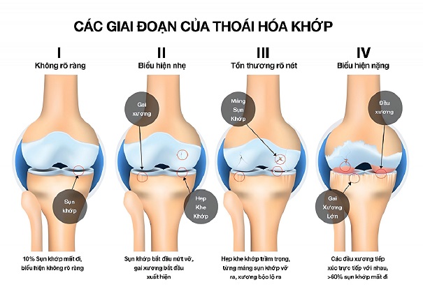 giai-doan-cua-thoai-hoa-khop