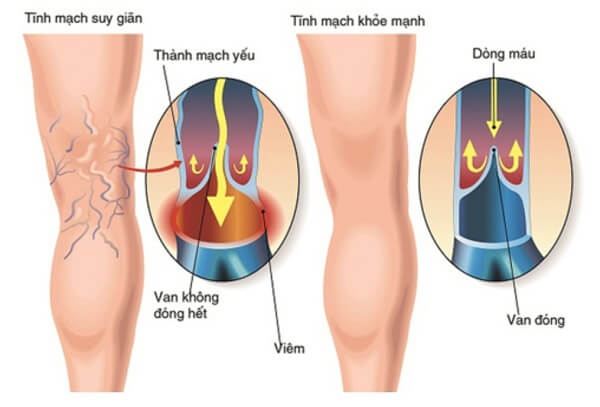 he-tinh-mach-chi-duoi-va-benh-suy-gian-tinh-mach-1