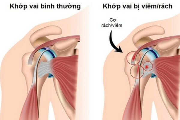 hieu-ve-benh-ly-viem-quanh-khop-vai