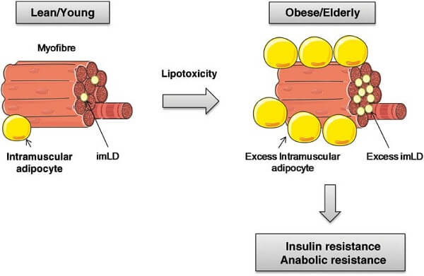 mo-trong-co-bap-intramuscular-triglycerides