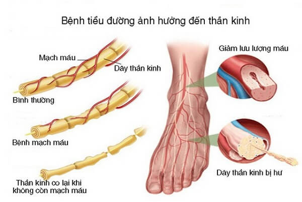 nguyen-nhan-benh-ly-than-kinh-ngoai-bien-2