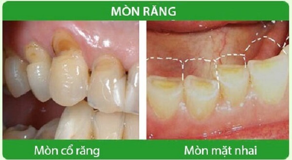 su-dung-may-chay-bo-co-the-gay-mon-rang-4