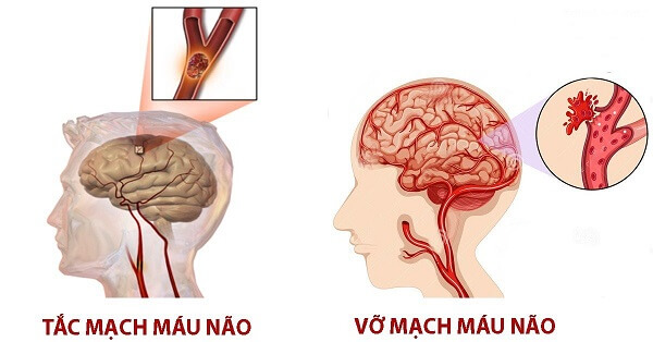 Máy tập vật lý trị liệu cho người tai biến phổ biến nhất