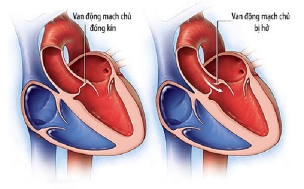 thay-doi-loi-song-de-phong-ngua-bien-co-tim-mach-10