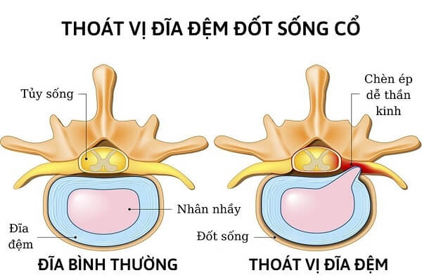 thoat-vi-dia-dem-cot-song-co