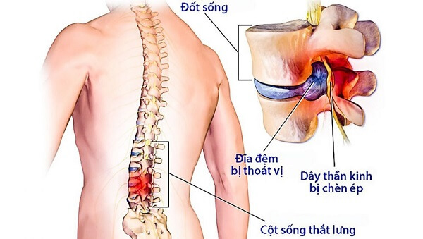 thoat-vi-dia-dem-gay-benh-ly-tai-cot-song