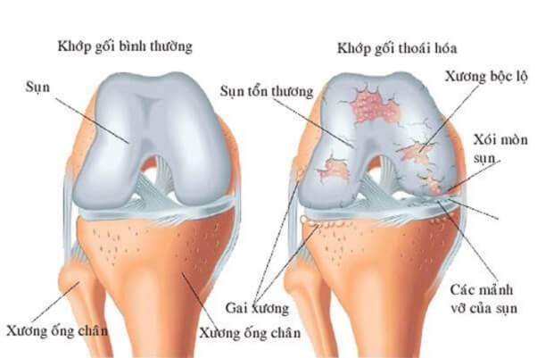 ton-thuong-sun-khop