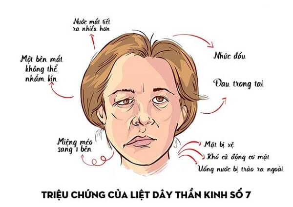 trieu-chung-liet-day-than-kinh-so-7