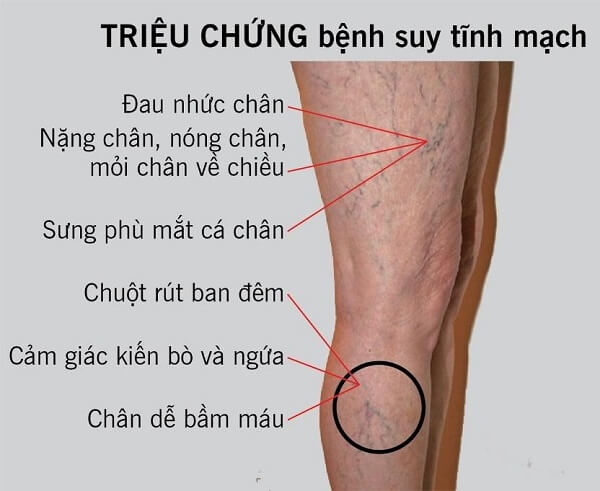 trieu-chung-suy-gian-tinh-mach-chan