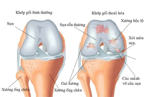 viem-khop-dang-thap-nguyen-nhan-trieu-chung-va-cach-dieu-tri-5